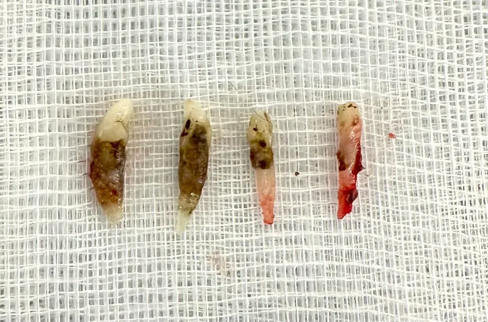 Extraction de dents